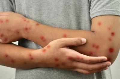 Brasil registra 88 casos de Mpox em 2026; saiba como evitar a doença