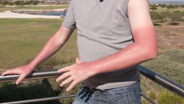 Verão aumenta riscos de micose, queimaduras e manchas na pele