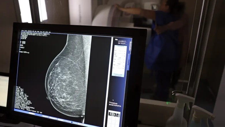 Câncer de mama: uma em cada três pacientes tem menos de 50 anos