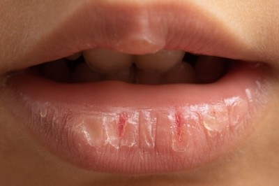 Onda de calor eleva risco de desidratação e exige atenção redobrada com a hidratação