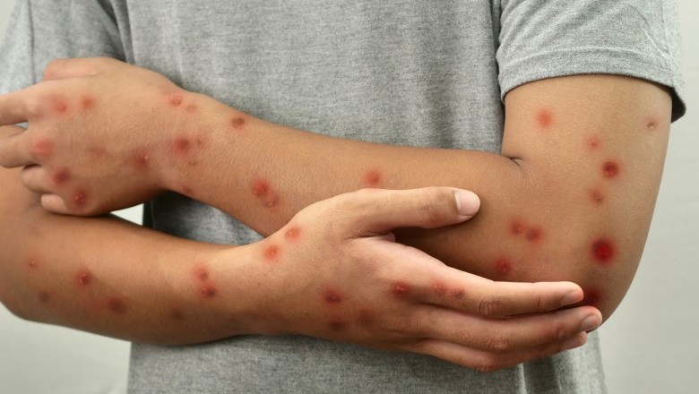 Brasil registra 88 casos de Mpox em 2026; saiba como evitar a doença
